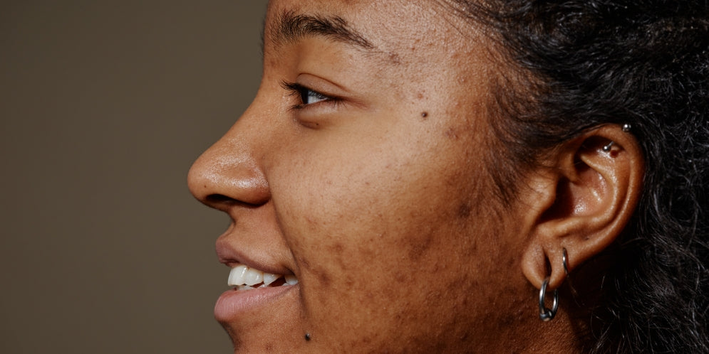 Cicatrice da acne: tipologie e rimedi