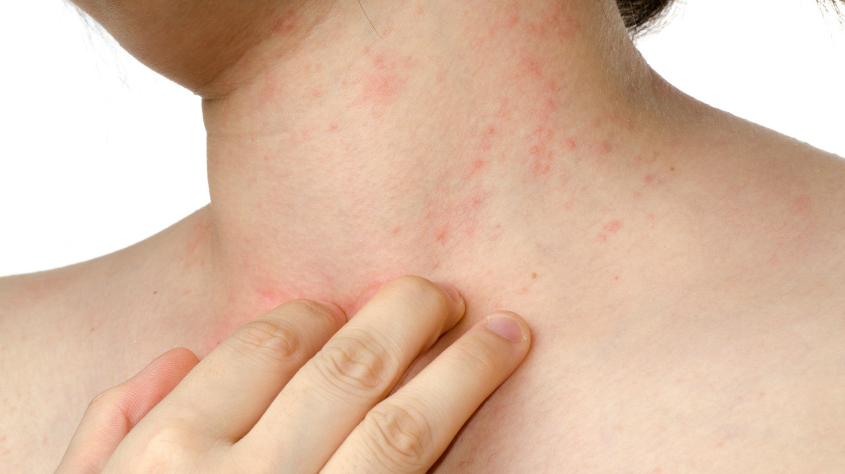 Dermatite da stress: cos'è e come riconoscerla e rimedi in farmacia
